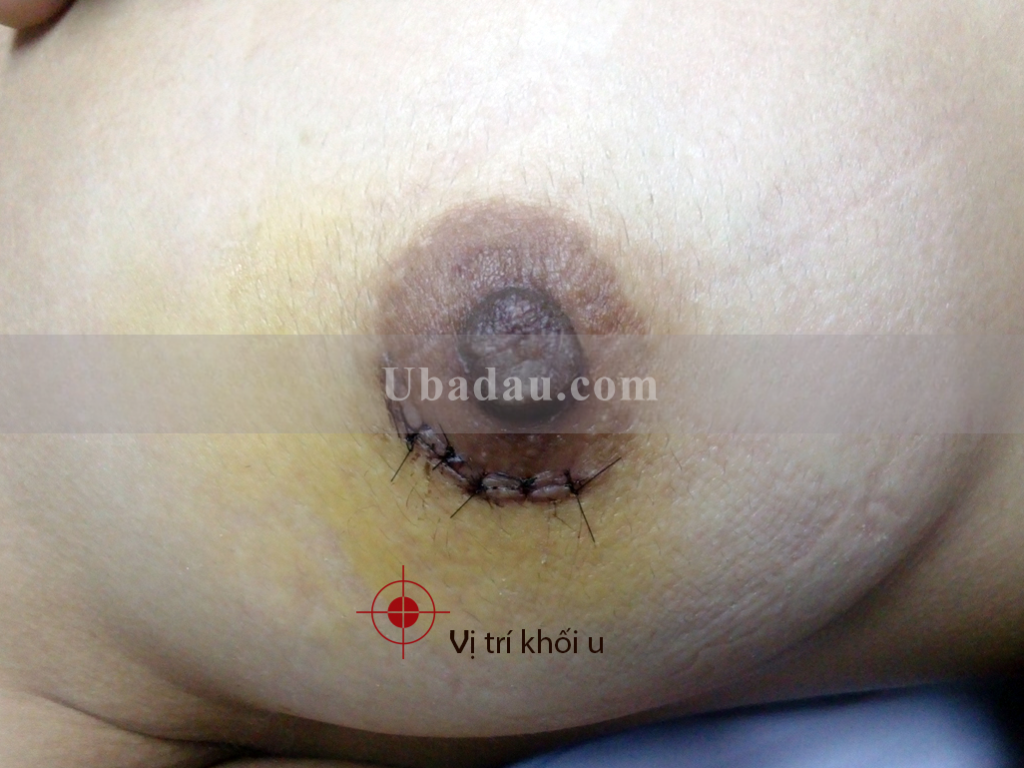 U nằm khá sâu nên việc nhận biết u bã đậu cũng trở nên khó khăn hơn