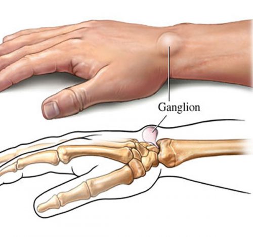 Hình ảnh u bao hoạt dịch ở cổ tay