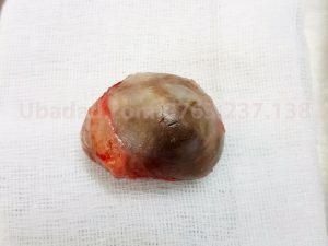 tiểu phẫu u bã đậu vùng cùng cụt
