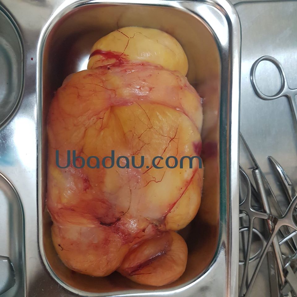 U mỡ khổng lồ ở lưng khi lấy ra