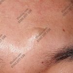 Hình ảnh u bã đậu ở trán