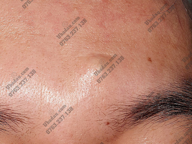 Hình ảnh u bã đậu ở trán