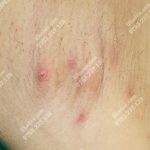 Hình ảnh u bã đậu ở nách nhiễm trùng