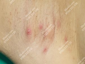 Hình ảnh u bã đậu ở nách nhiễm trùng