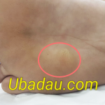 U bã đậu ở bàn chân