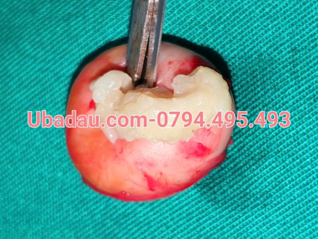 U bã đậu ở nách chưa nhiễm trùng