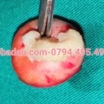 U bã đậu ở nách chưa nhiễm trùng