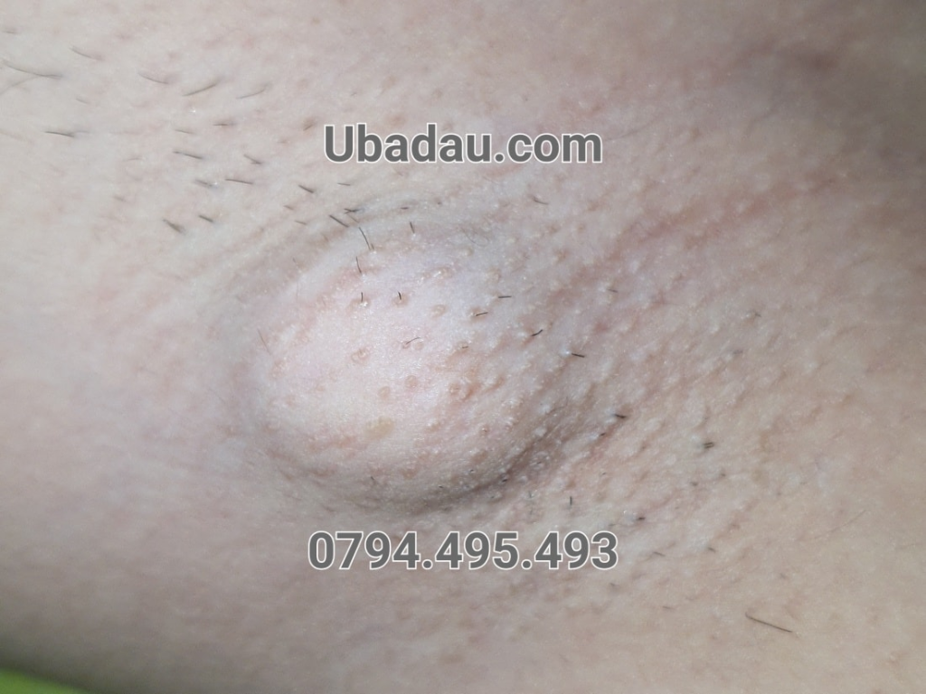 U bã đậu ở nách chưa nhiễm trùng