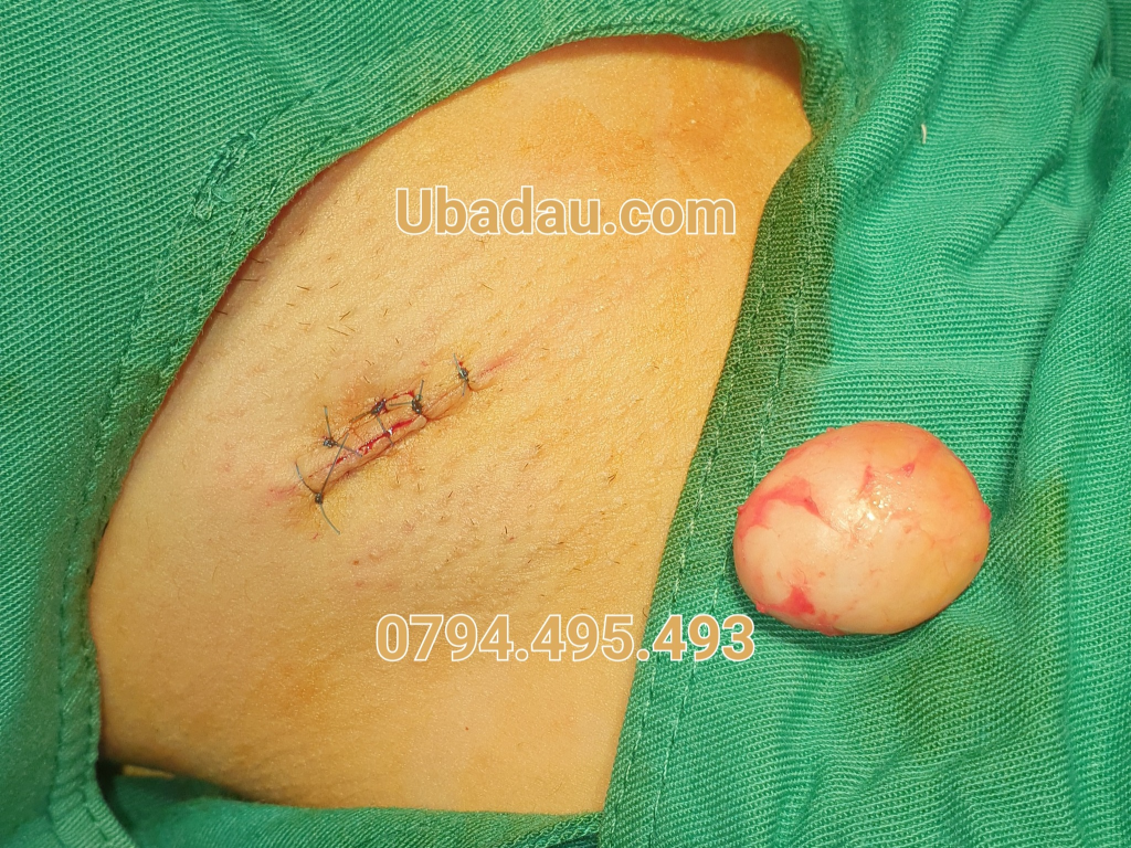 U bã đậu ở nách sau khi được lấy ra