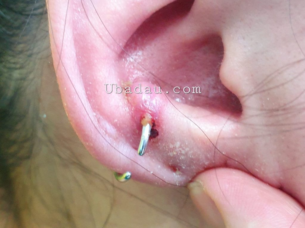 Xỏ khuyên tai bị nhiễm trùng là nguyên nhân phổ biến dẫn đến u sụn