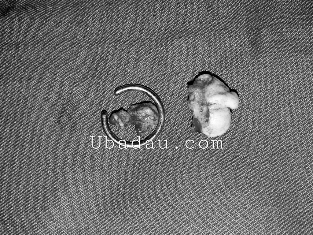 U sụn vành tai sau khi tiểu phẫu ra