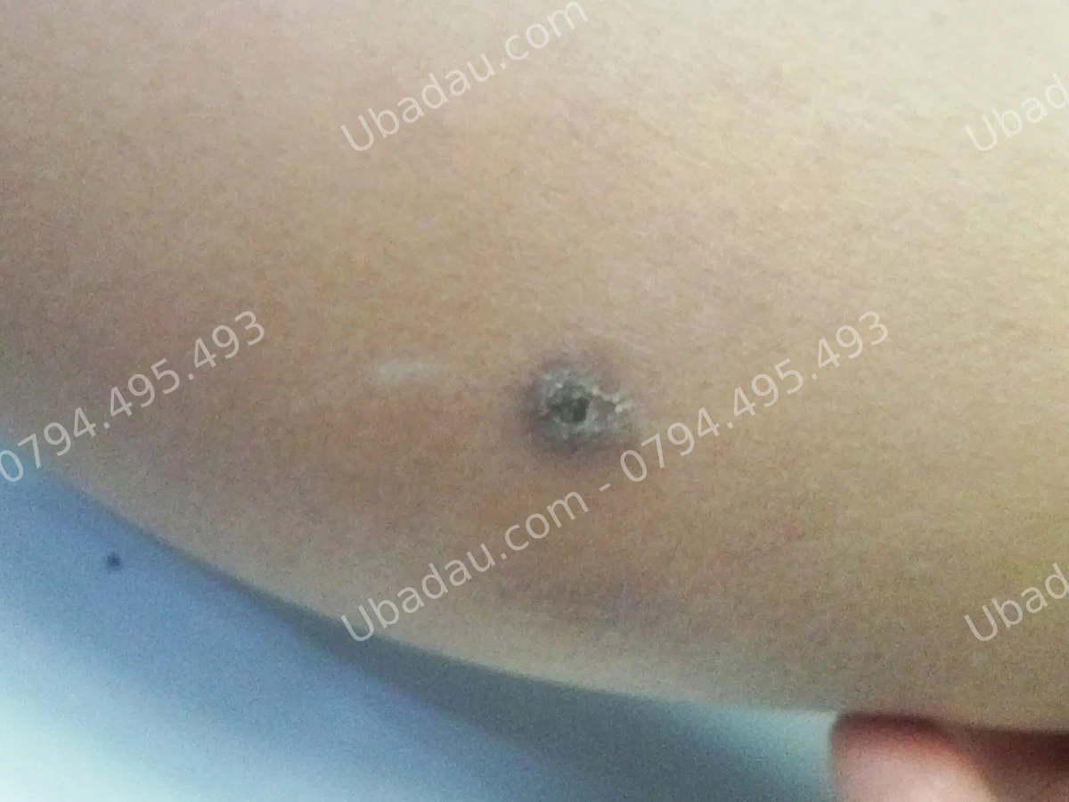 nguyên nhân gây u bã đậu nguyên nhân gây u bã đậu