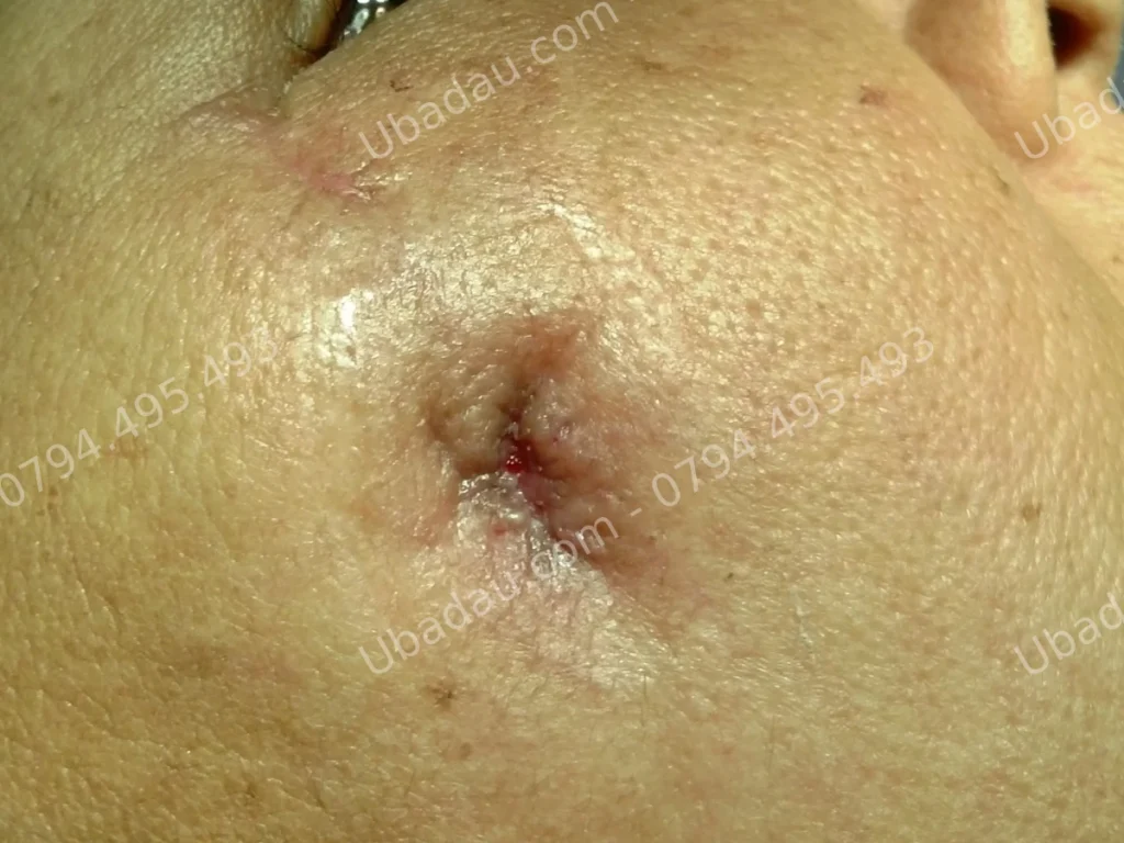 U bã đậu ở mặt nhiễm trùng