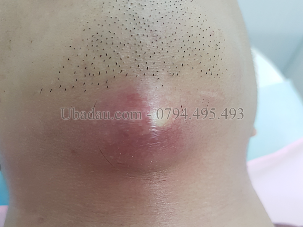 U bã đậu ở cố nhiễm trùng