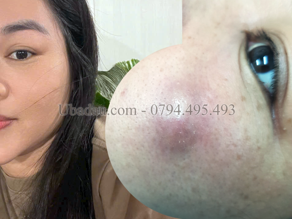 Bạn nữ bị u bã đậu ở mặt và để khá lâu, tới khi sưng đau bạn mới đến tiểu phẫu