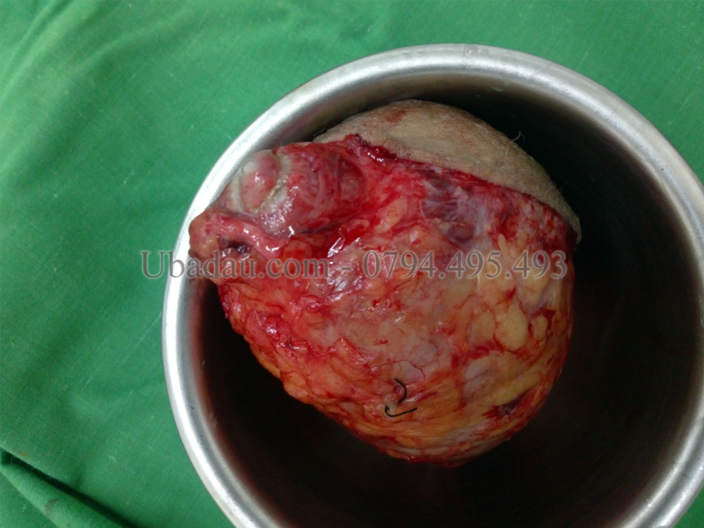 Khối u bã đậu ở mông sau khi tiểu phẫu ra