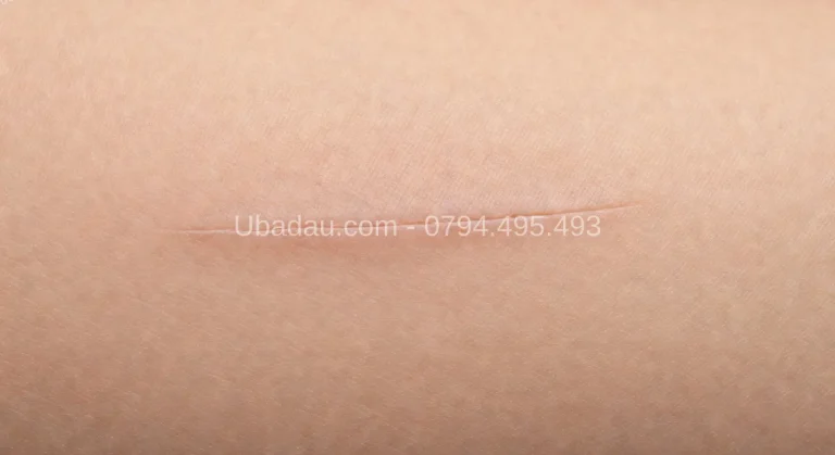 Chăm sóc sau tiểu phẫu u mỡ – Hồi phục và kiêng cữ