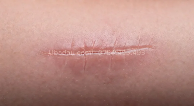 Bao lâu sau tiểu phẫu u bã đậu thì lành và trở lại bình thường?