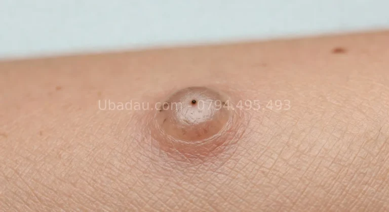 Triệu chứng nhận biết u bã đậu – dấu hiệu từ sớm