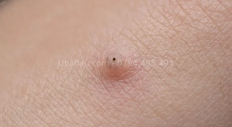 U Bã Đậu (Sebaceous Cyst): Tổng Hợp Toàn Diện – Nguyên Nhân, Điều Trị và Phòng Ngừa