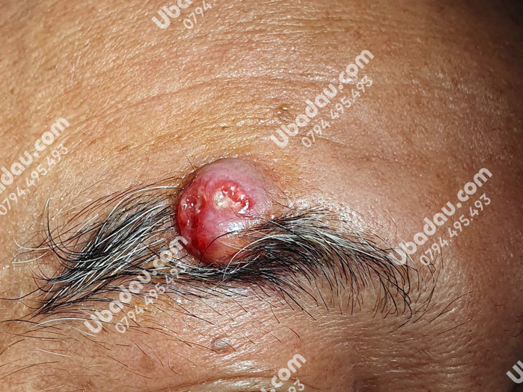 U bã đậu ở chân mày nhiễm trùng