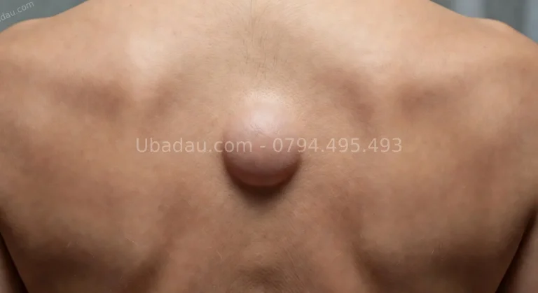 U bã đậu ở lưng – Nhận biết, nguyên nhân và điều trị