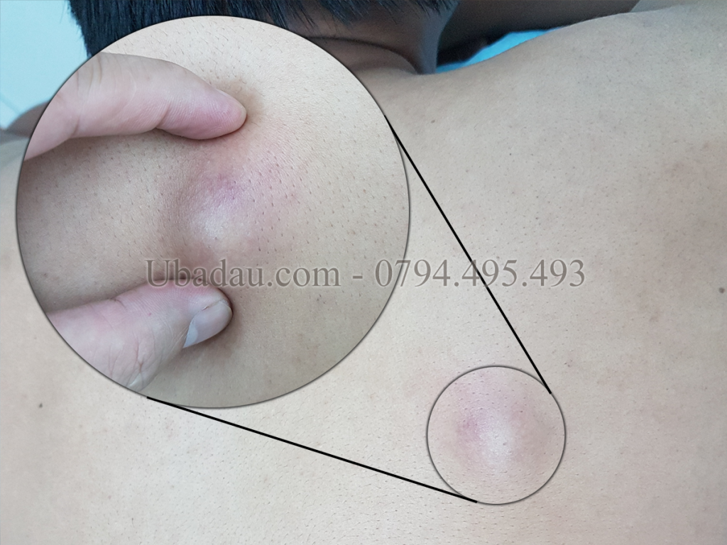 U bã đậu ở lưng chưa nhiễm trùng