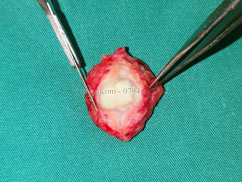 Khối u khi được lấy ra