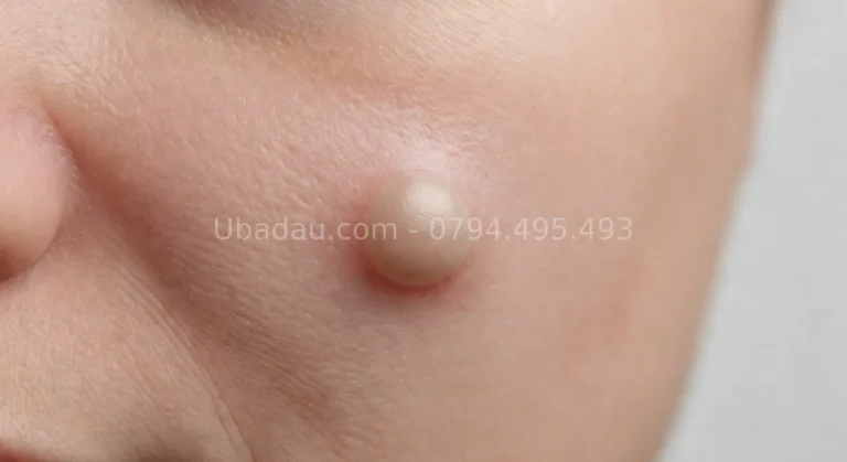U bã đậu ở mặt – Điều trị không để lại sẹo