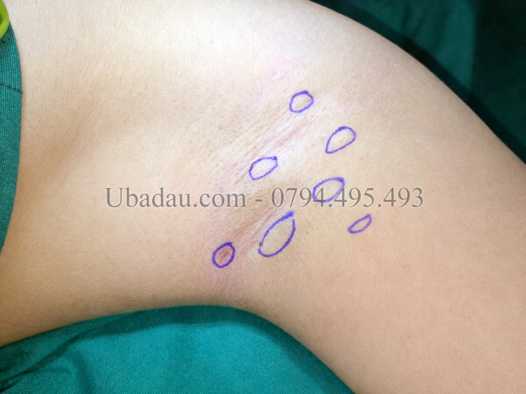 Nhiều u bã đậu ở nách