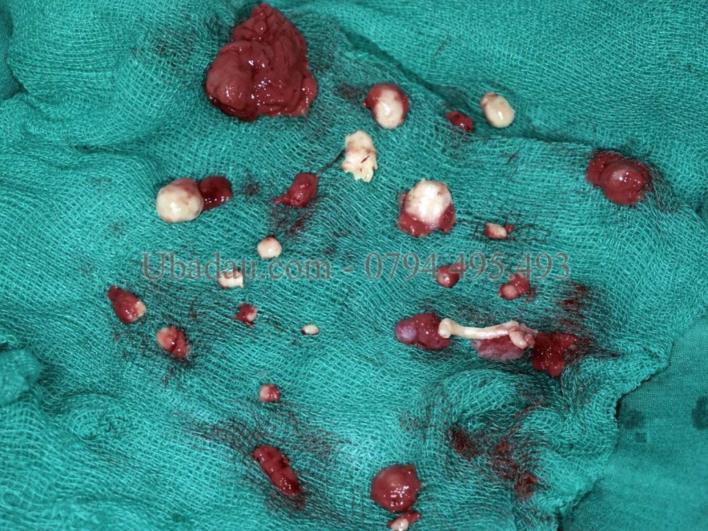 Rất nhiều khối u được lấy ra từ vùng nách, nhiều hơn ban đầu đánh dấu