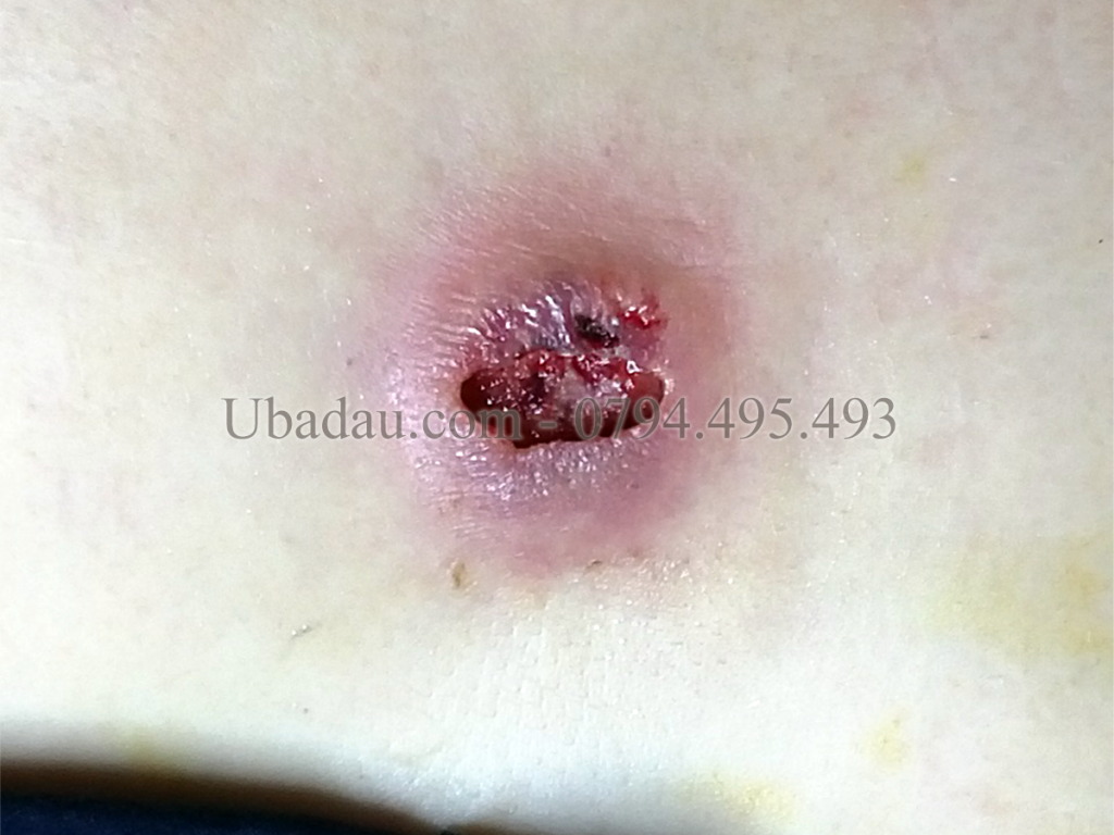 U bã đậu ở ngực sau khi tự điều trị bằng mẹo dân gian