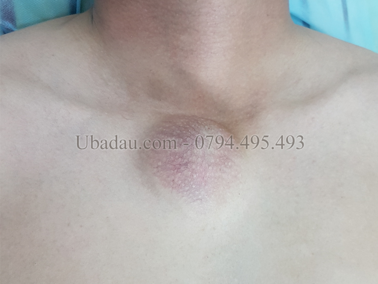 Ca bệnh: U bã đậu ở ngực để lâu năm bị biến chứng