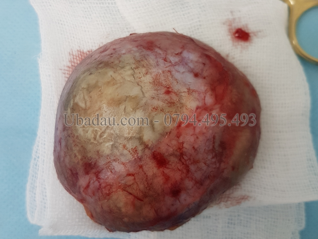 Khối u khổng lồ sau khi lầy ra
