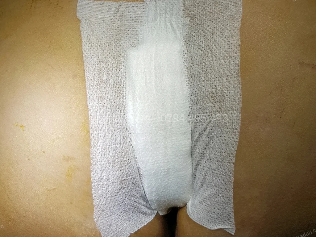U bã đậu vùng cùng cụt