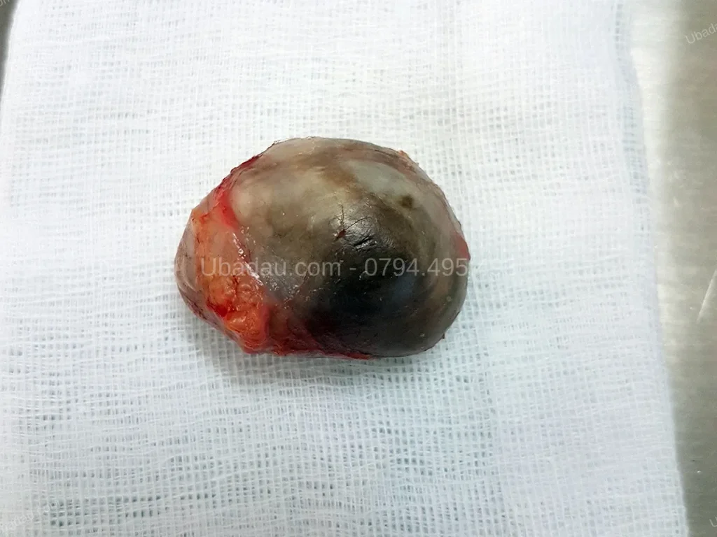 U bã đậu vùng cùng cụt
