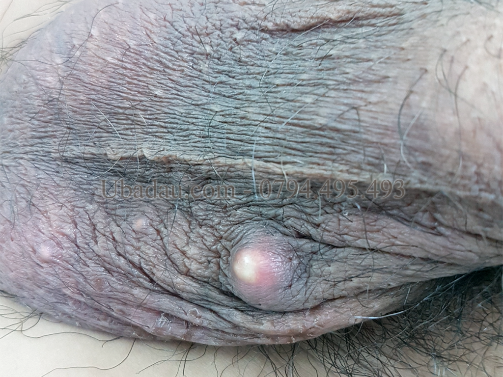 U bã đậu ở bìu cũng là vị trí khá phổ biến