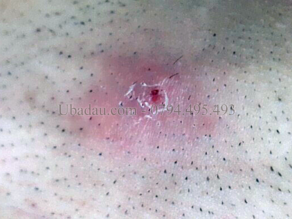 U bã đậu vùng mu đã viêm nhiễm