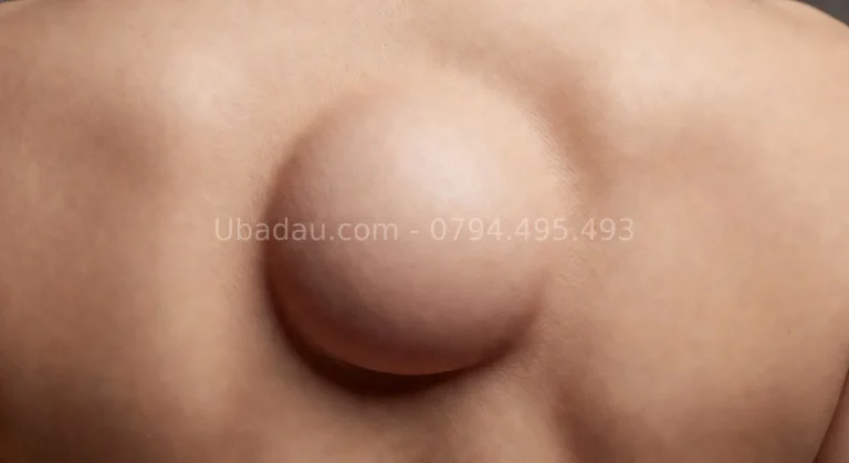 U mỡ là gì? Phân biệt u mỡ và u bã đậu