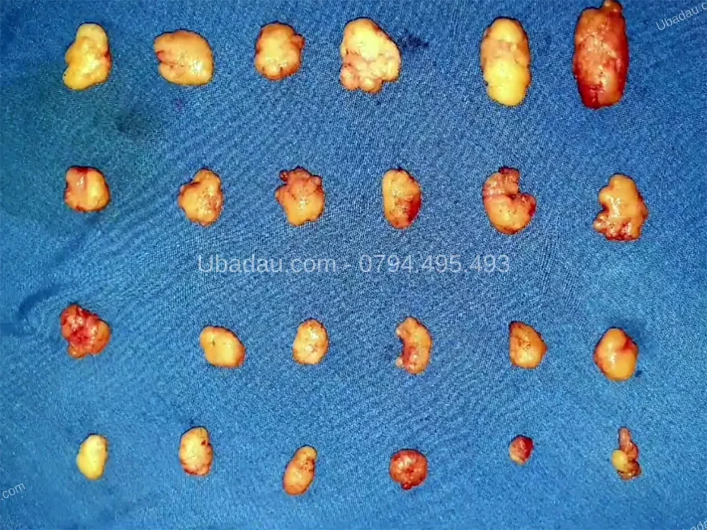 Video tiểu phẫu u mỡ