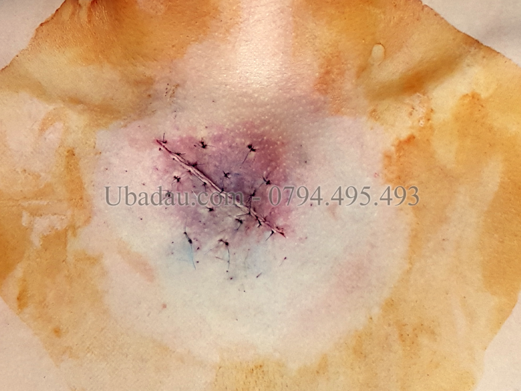 Vết mổ sau khi tiểu phẫu, đã cố gắng hết sức để vết mổ đẹp nhất có thể