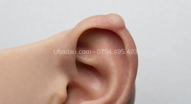 U Sụn Vành Tai: Nguyên Nhân, Triệu Chứng và Phương Pháp Điều Trị Hiệu Quả