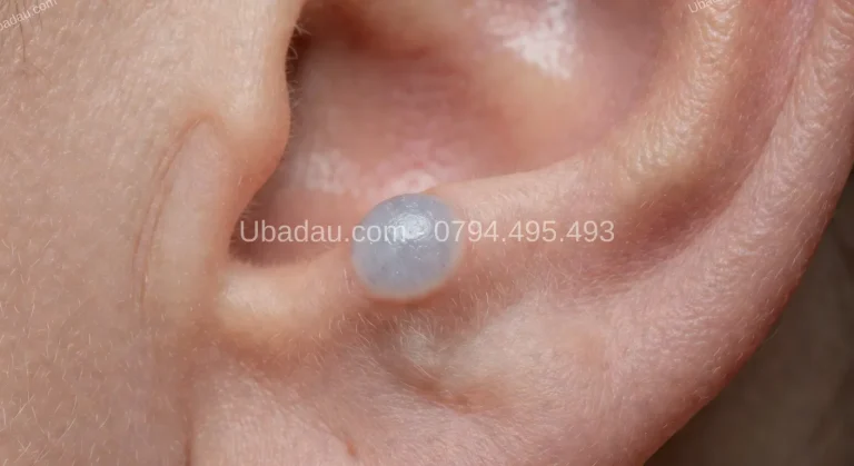 U sụn vành tai là gì? Nguyên nhân hình thành và cách nhận biết
