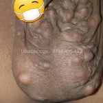 Đa u bã đậu ở bìu