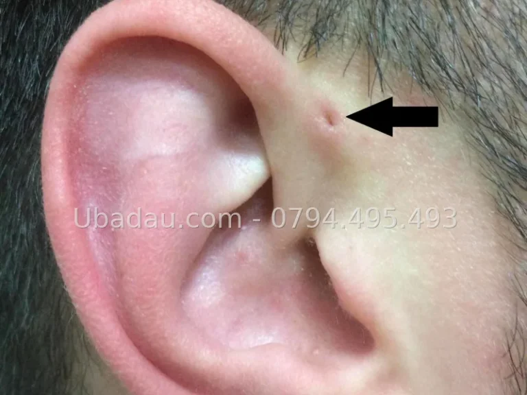 Áp xe rò luân nhĩ — khi nào cần mổ ngay?