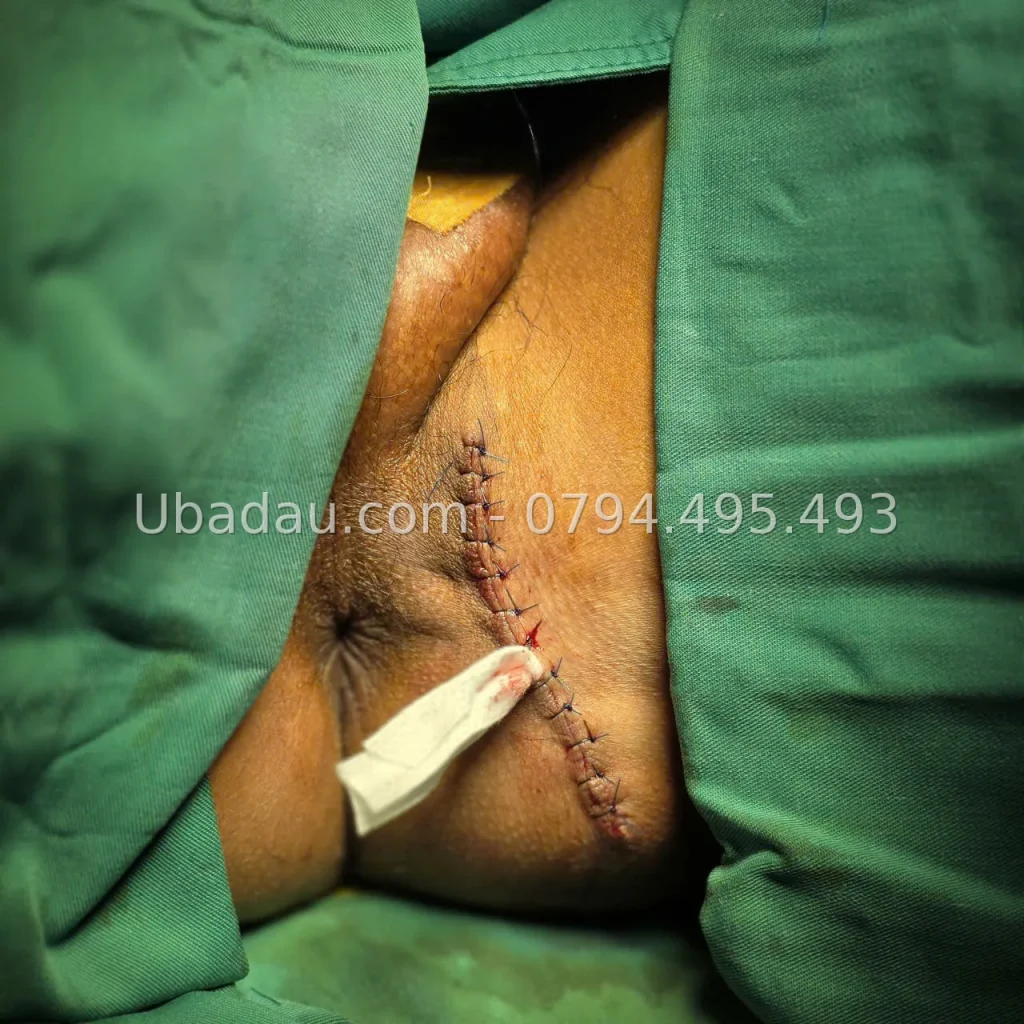 U bã đậu vùng bẹn – hình 4