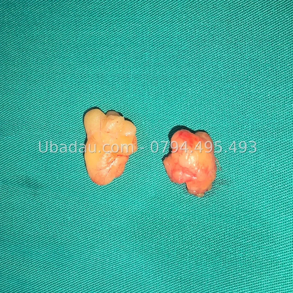 U mỡ ở đùi: ca hai khối u mang nhiều năm, tới khi đạp xe thấy cấn mới mổ