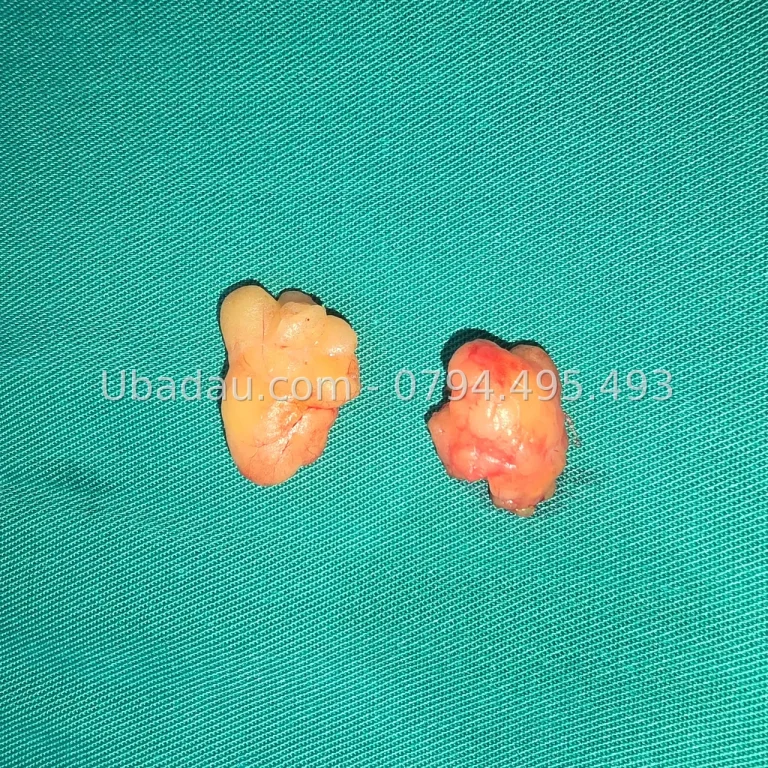 U mỡ ở đùi: ca hai khối u mang nhiều năm, tới khi đạp xe thấy cấn mới mổ