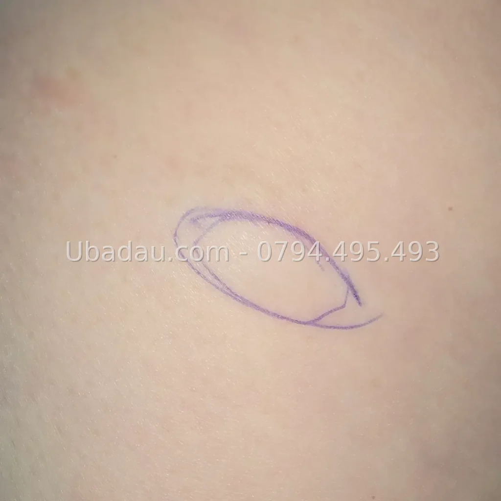 U mỡ ở đùi – hình 3